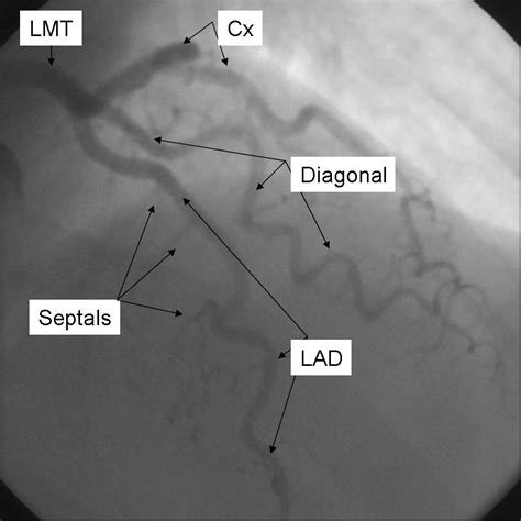 Coronary angiography standard views - wikidoc