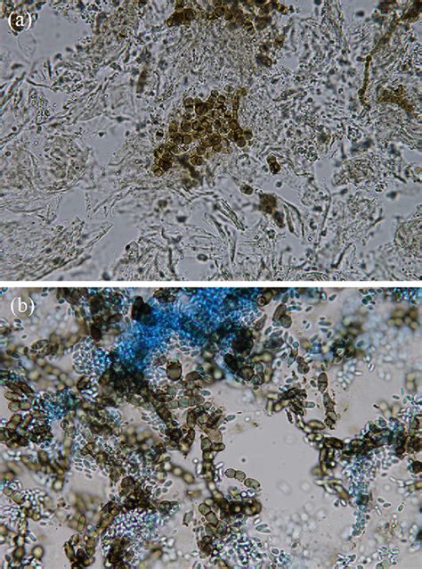 Superficial Phaeohyphomycosis Caused By Aureobasidium Melanogenum