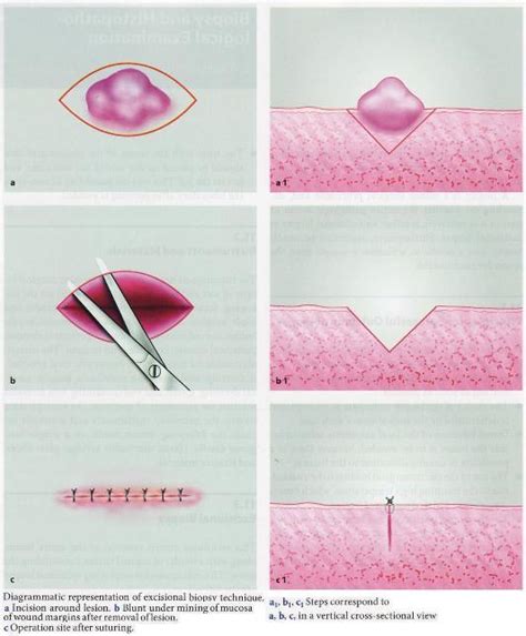 Your doctor will give you instructions based on the type of biopsy being performed. Diagnosis - Canadian Cancer Survivor Network