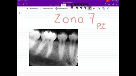 Lo Que Se Ve En Una Radiograf A Dental Zona De Premolares Inferiores