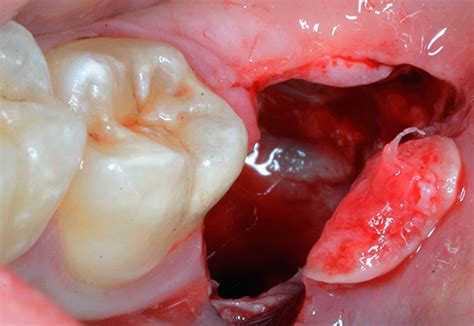 It is important to know the complications of tooth extraction that could occur in order to correctly consent a patient. Complications after tooth extraction (including wisdom ...