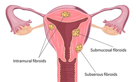 Medanta What Are Uterine Fibroids And How Does It Affect Your Body