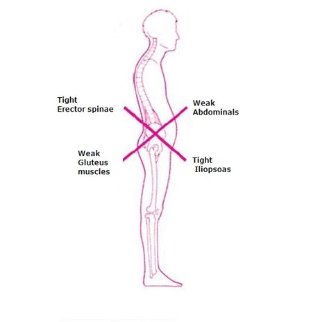 Lower Crossed Syndrome Medical Diagram Crooked Man Muscle Strength Imbalance Stock Illustration