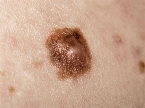 What Is Stage 4 Melanoma Skin Cancer Cancerwalls