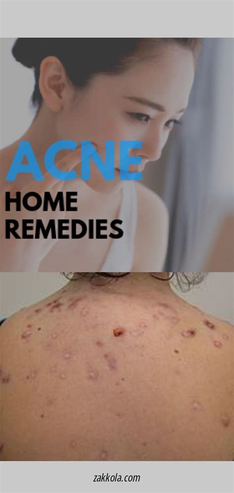 How To Get Rid Of Pimples Acne Overnight Fast Skincare Pimples