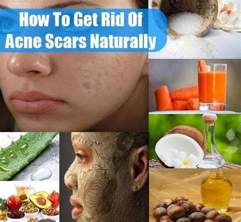 How To Get Rid Of Acne Scars Naturally Diy Home Things
