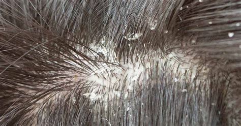 What Are The Different Types Of Dandruff Flakes And How To Stop Them