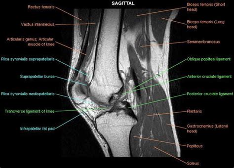 Scroll through the structures to understand the anatomy. Shoulder MRI | SAATNYA BELAJAR MRI: ANTERIOR CRUCIATE LIGAMENT INJURY | Knee mri, Cruciate ...