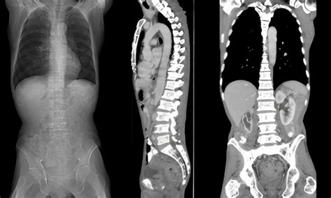 Ct Scan Spine