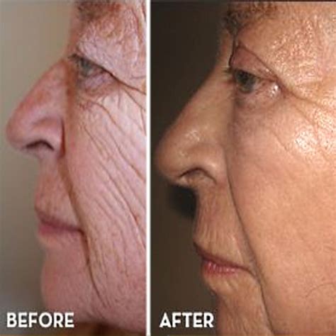 Top 104 Pictures Retin A Before And After Wrinkle Pictures Latest