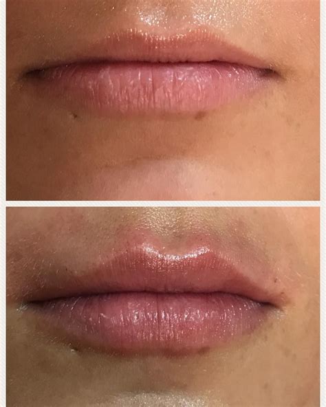 Lip Filler After Care Instructions Homes Of Heaven