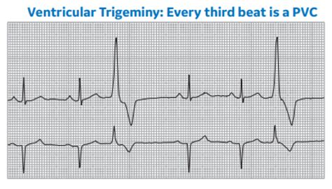 Arrhythmia Recognition Part 2 Clinical View