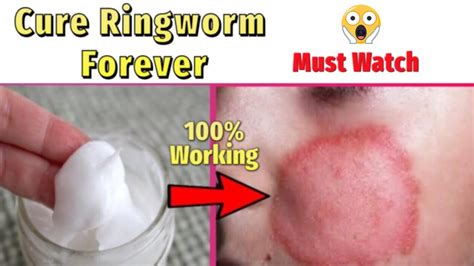 How To Cure Ringworm Permanently Home Remedies For Ringworm