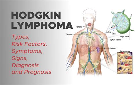 Hodgkin Lymphoma Types Risk Factors Symptoms Signs Diagnosis And