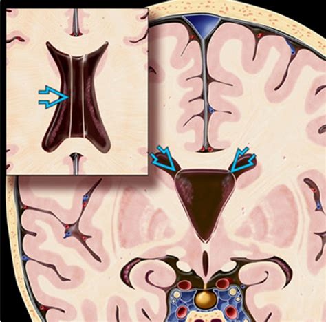 Cavum Septi Pellucidi Csp Brain Imaging