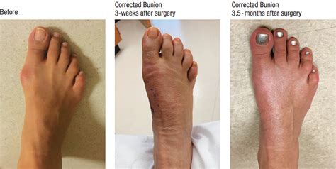 Bunion Treatment Portland Bunion Surgery Beaverton Rheumatoid