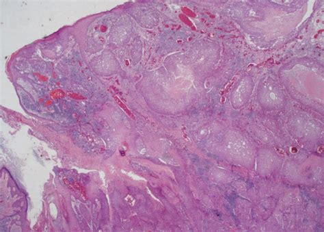 Primary Eccrine Porocarcinoma Of The Breast A Case Report And Review