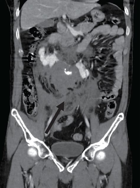 Ct Angiography In Coronal View Showing An Active Contrast
