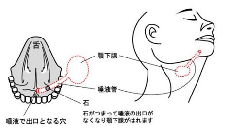 顎下腺唾石 - いのうえ耳鼻咽喉科