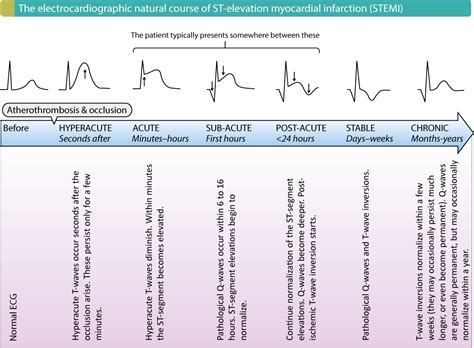 The Ecg In Assessment Of Myocardial Reperfusion Cardiovascular Education