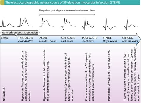 St Segment Elevation In Acute Myocardial Ischemia And Differential