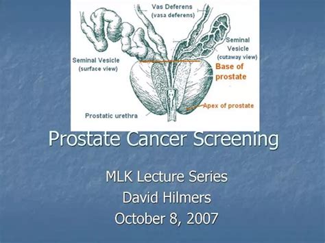 PPT Prostate Cancer Screening PowerPoint Presentation Free Download ID