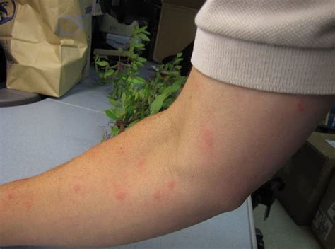 Bed Bug Bites Vs Mosquito Bites