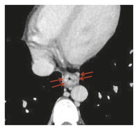 Esophageal Varices In A 38 Year Old Male With Liver Cirrhosis The