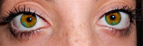 Heterochromia Eyes Of Different Colors Either By Genitics Injury Or