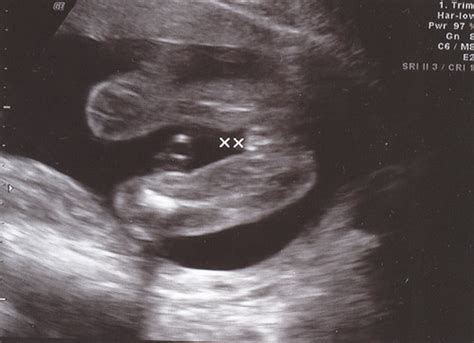 20 Weeks Ultrasound Girl Torrie Flickr