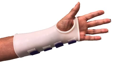 Distal Radius Fracture Raleigh Hand Surgery — Joseph J