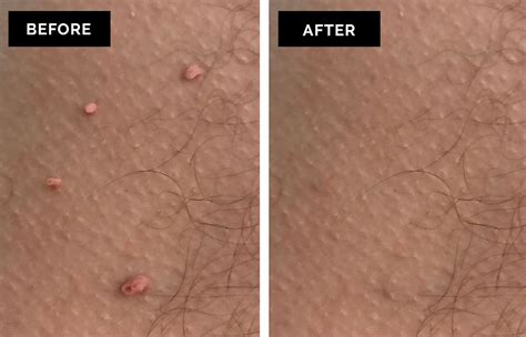A skin tag is a little growth on the skin. Skin Tag and Skin Blemish Removal in Birmingham by ...