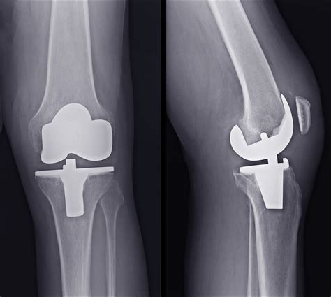 Recovery After A Total Knee Replacement Orthopedic Associates Of West