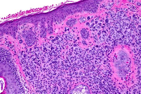Pathology Outlines Common Acquired Nevus