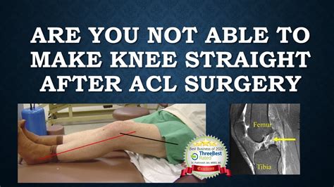 Are You Not Able To Make Your Knee Fully Straight After Acl Surgery