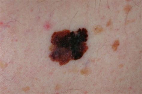 Whats New In The Latest Melanoma Guidelines Mdedge Internal Medicine