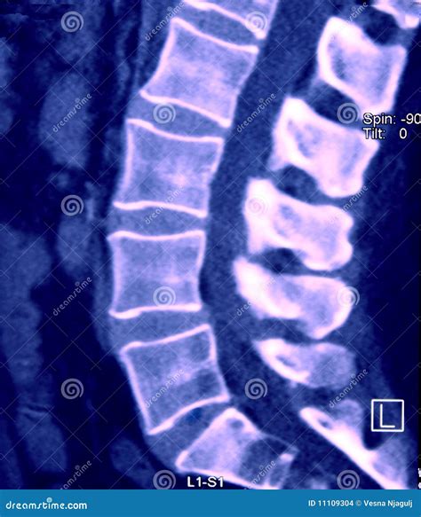 Ct Of Lumbar Spine Sagittal Plane Stock Photo Image Of Hernia