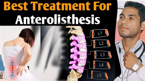 Anterolisthesis L5 S1 Treatment Spondylolisthesis Grade 1 Treatment