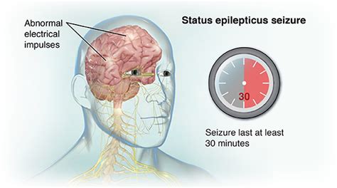 Status Epilepticus Health Encyclopedia University Of Rochester