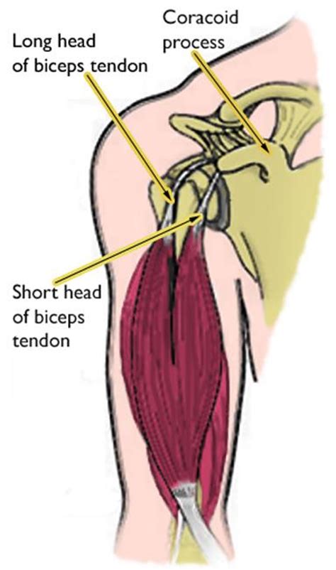 Long Head Of Biceps Pathology At Shoulder Adam Watson Orthopaedic