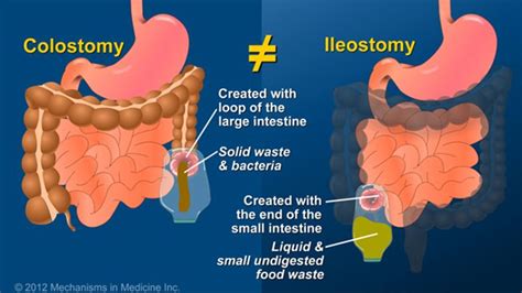 It Is Important To Know That An Ileostomy Is Not A Colostomy An