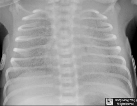 Check spelling or type a new query. LearningRadiology - Respiratory Distress Syndrome of the ...
