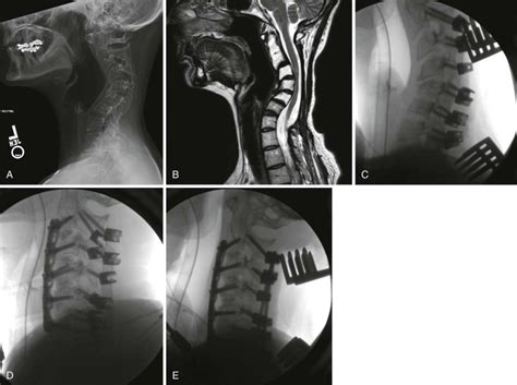 Anterior And Posterior Cervicothoracic Junction Stabilization