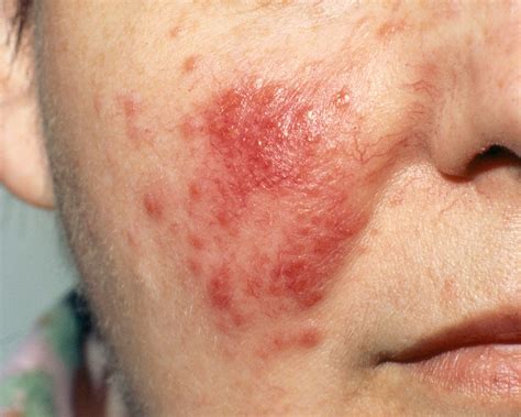 Why Red Spots Are Suddenly Showing Up On Your Skin Artofit
