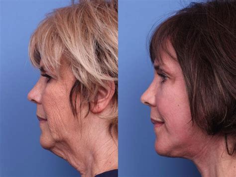 Facelift Before And After Pictures Case 73 Scottsdale Az Hobgood Facial Plastic Surgery