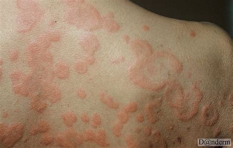What Are The Causes Of Chronic Urticaria And What Is The Best Treatment