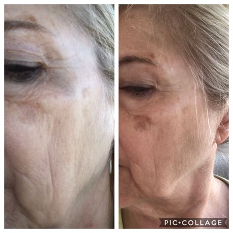 Gundry MD Polyphenol Dark Spot Diminisher | Dark Spot Skin Care