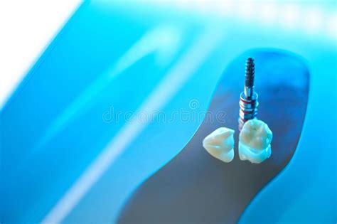 Photo Of Teeth And Dental Pin For Restoration Of Tooth Stock Photo