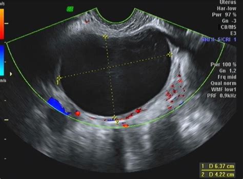 We did not find results for: Transvaginal ultrasound in a 25-year-old woman. Notes ...