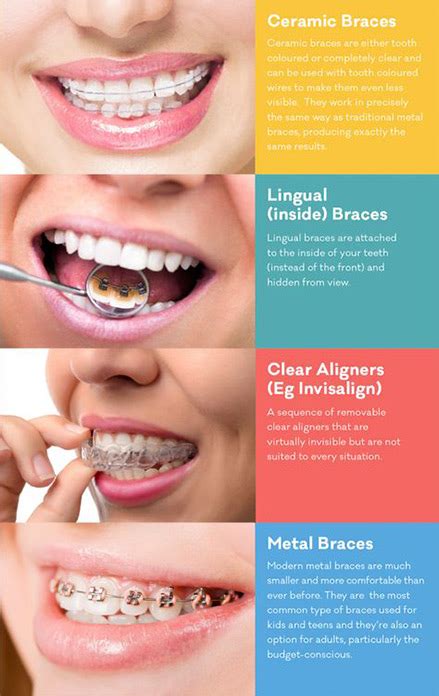 The 5 Common Types Of Braces And Their Cost Elegantdentcare Blog